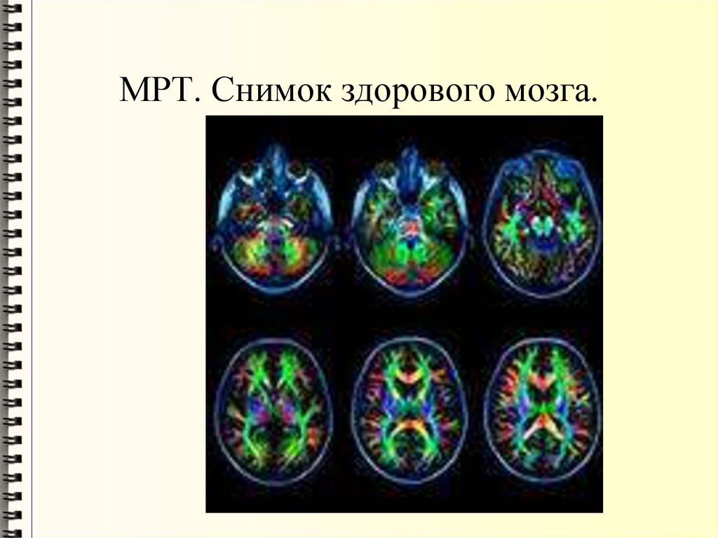 МРТ. Снимок здорового мозга.