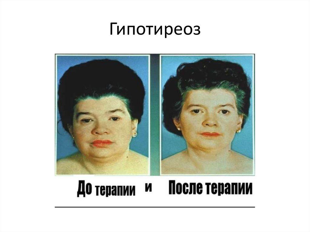 Гипотиреоз