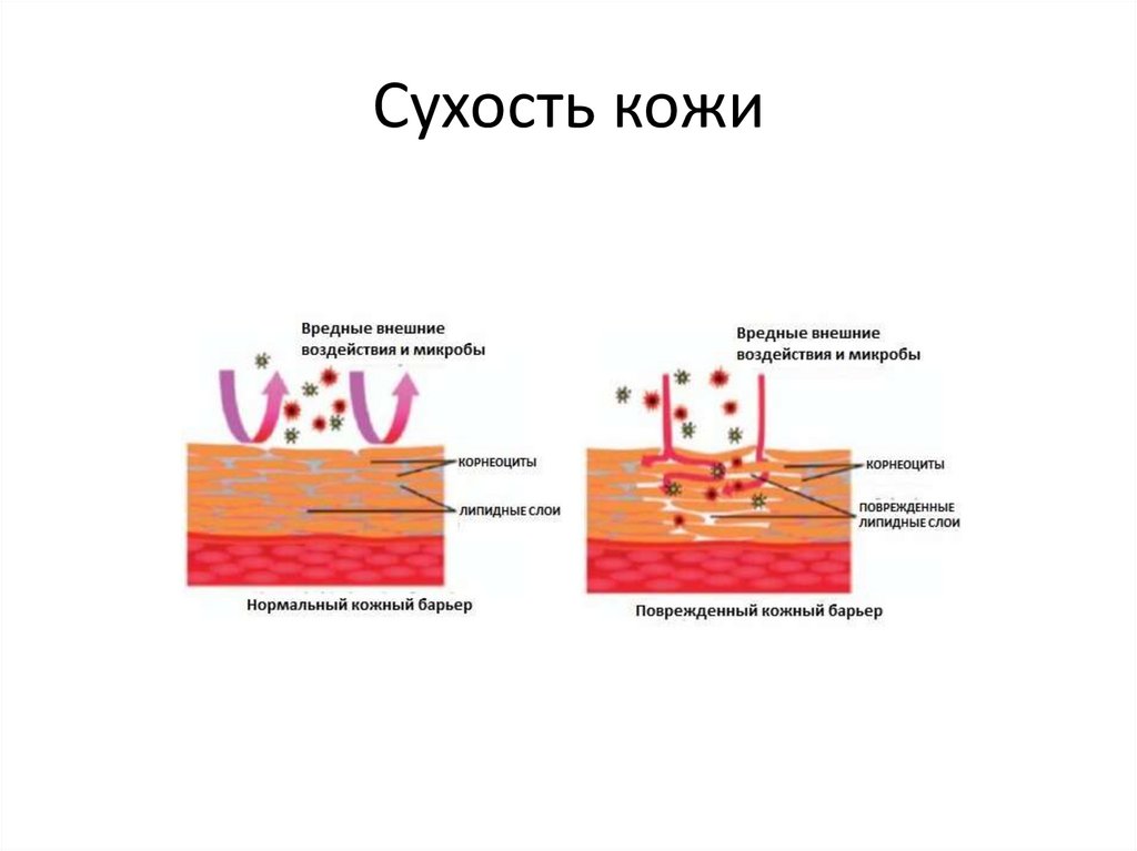 Сухость кожи