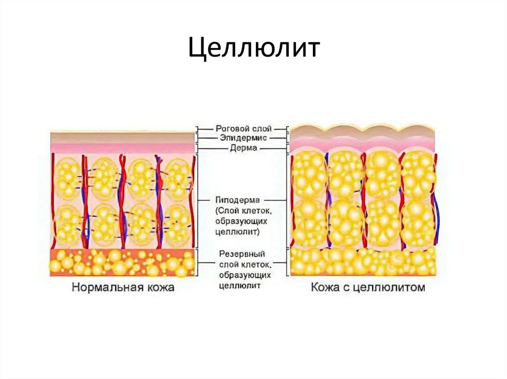 Целлюлит