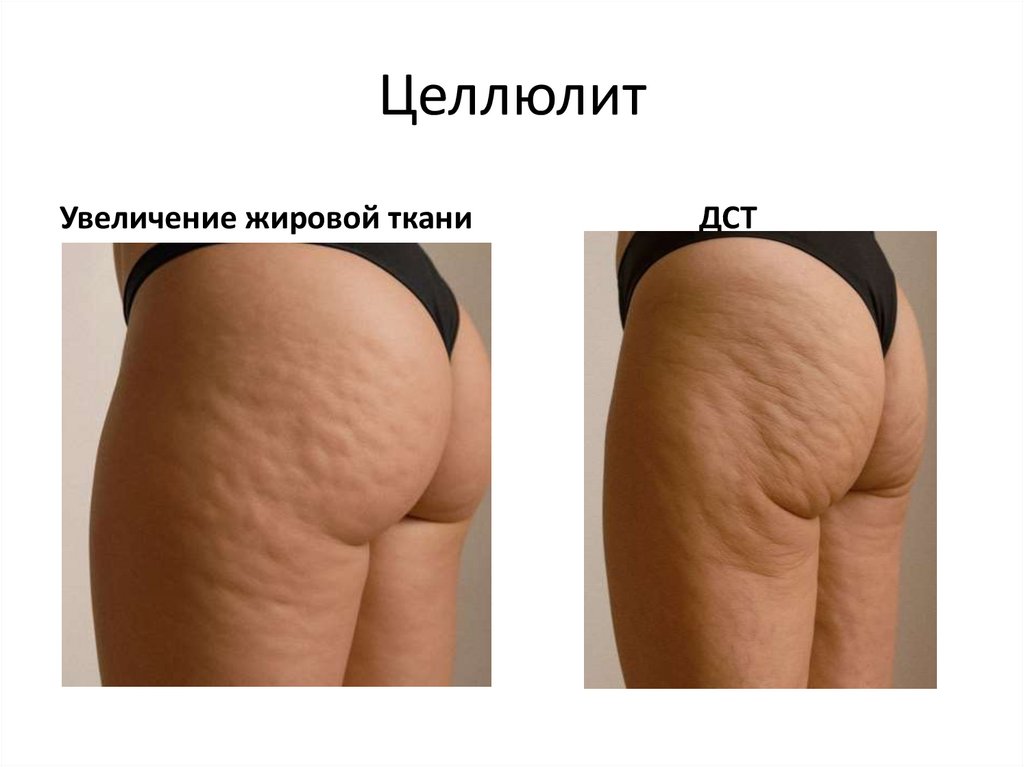 Целлюлит