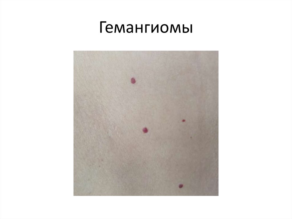 Гемангиомы