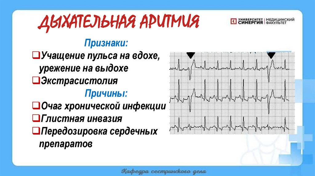 ДЫХАТЕЛЬНАЯ АРИТМИЯ