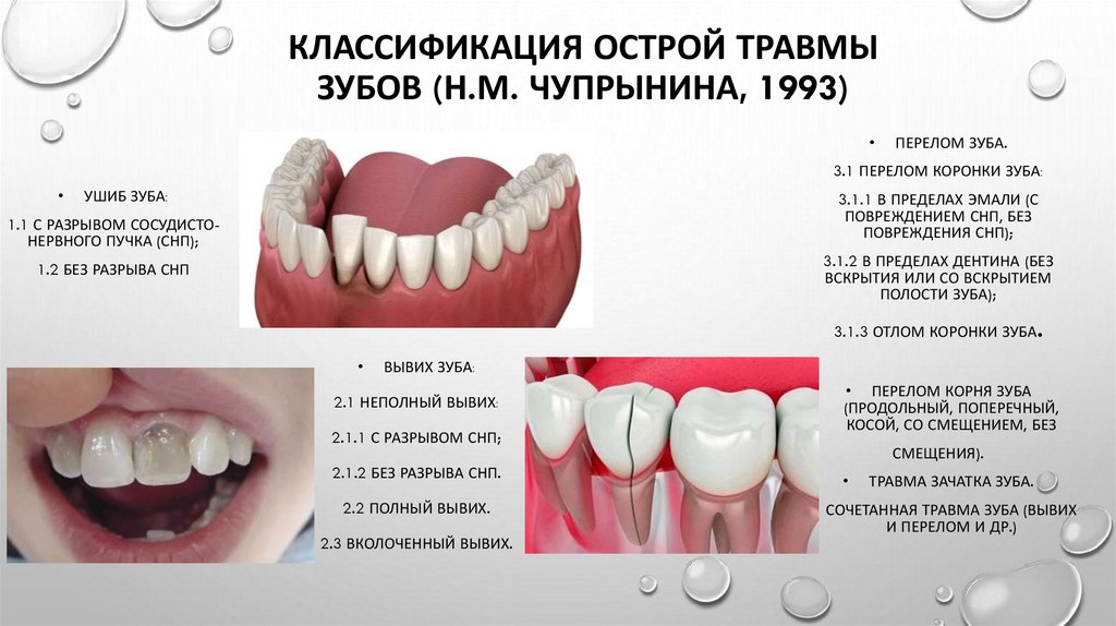 Классификация острой травмы зубов (Н.М. Чупрынина, 1993)