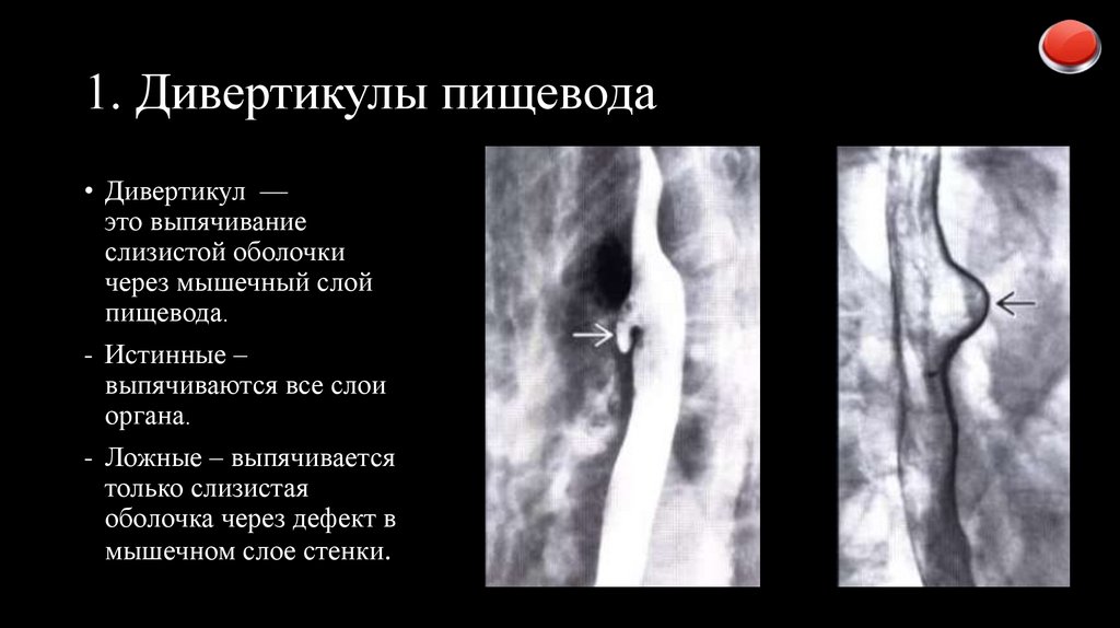 1. Дивертикулы пищевода