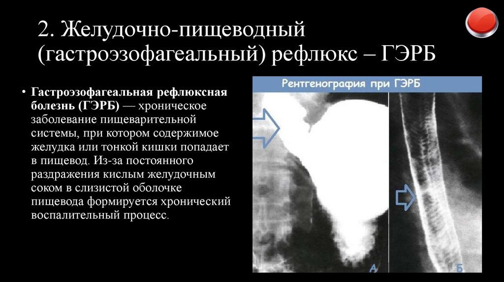 2. Желудочно-пищеводный (гастроэзофагеальный) рефлюкс – ГЭРБ