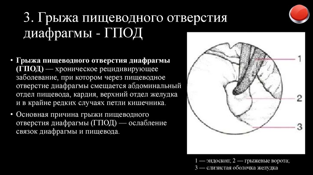 3. Грыжа пищеводного отверстия диафрагмы - ГПОД