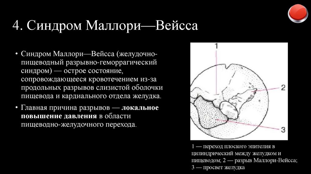 4. Синдром Маллори—Вейсса