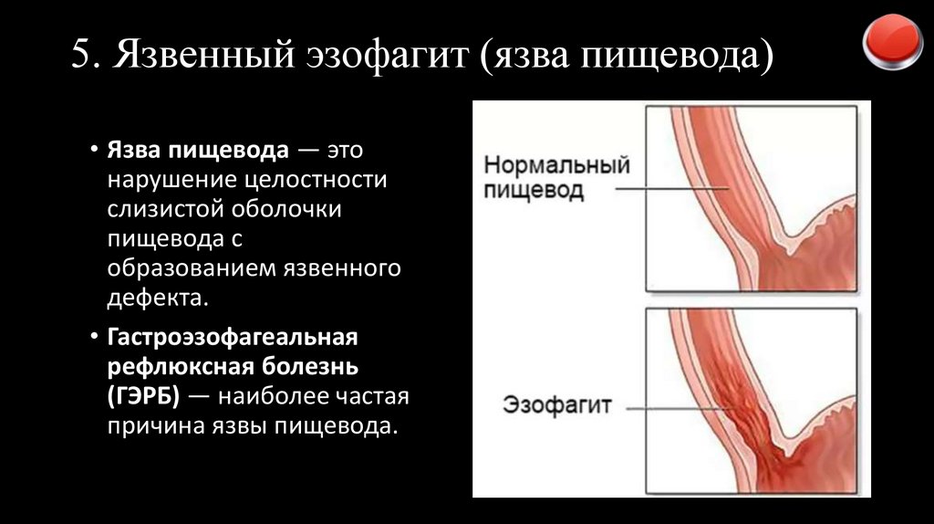 5. Язвенный эзофагит (язва пищевода)