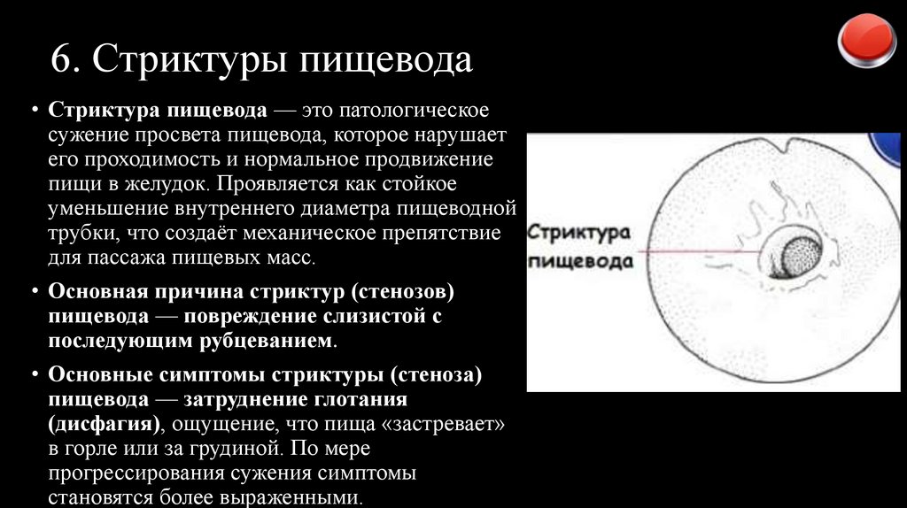 6. Стриктуры пищевода