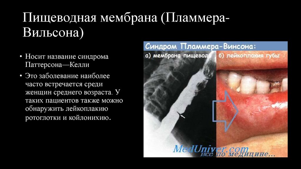 Пищеводная мембрана (Пламмера-Вильсона)