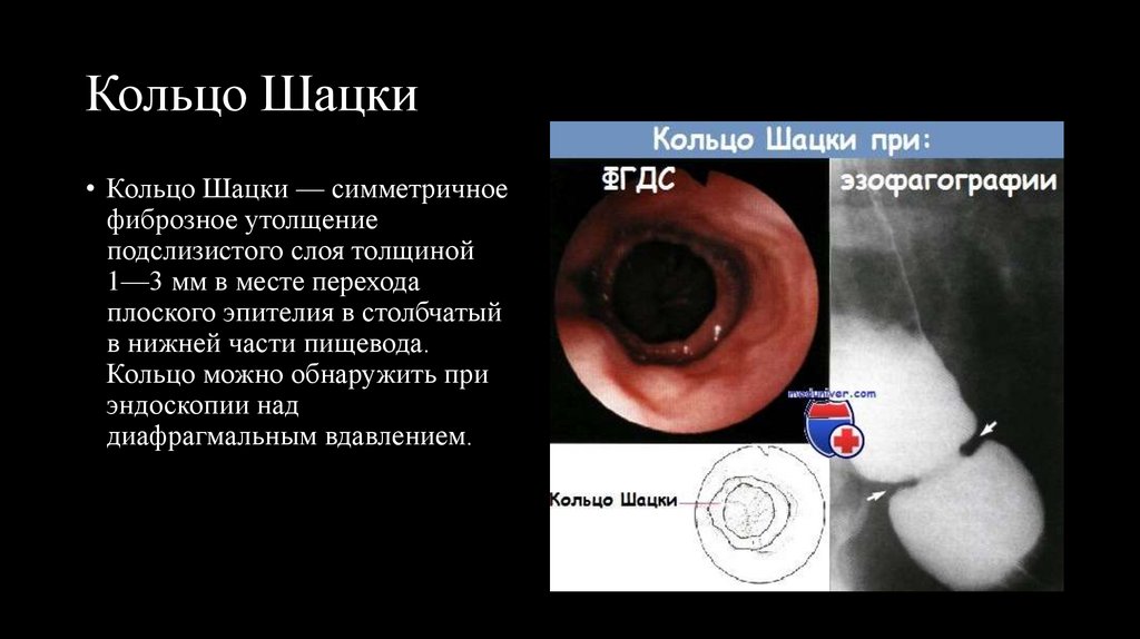 Кольцо Шацки