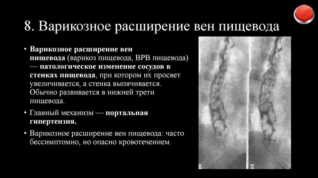 8. Варикозное расширение вен пищевода