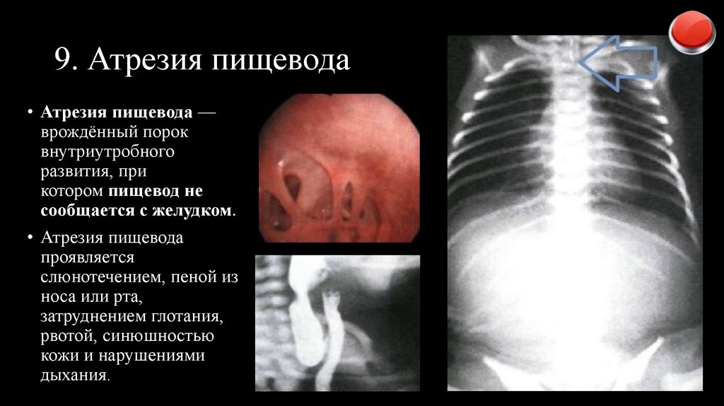 9. Атрезия пищевода