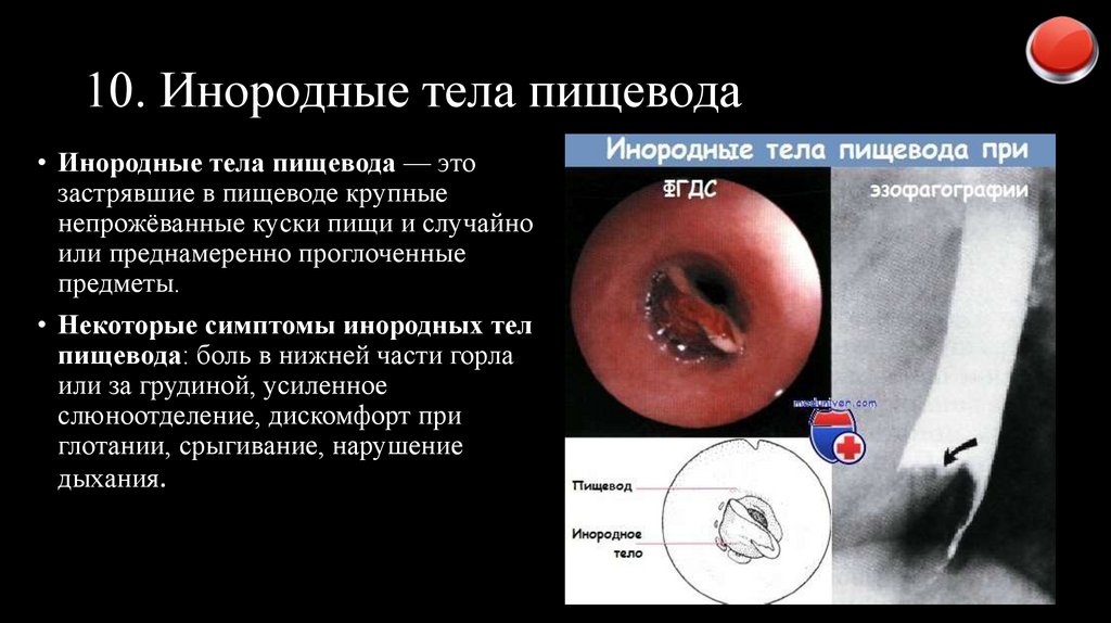 10. Инородные тела пищевода