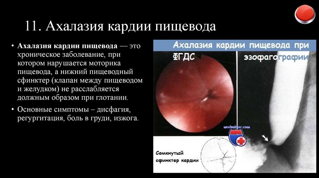 11. Ахалазия кардии пищевода