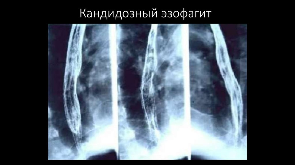 Кандидозный эзофагит