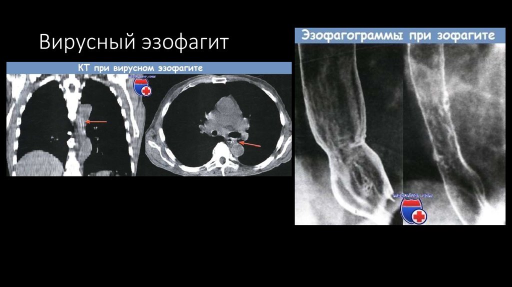 Вирусный эзофагит