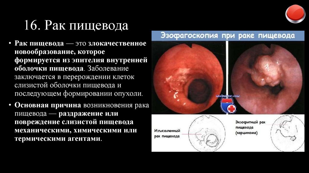 16. Рак пищевода