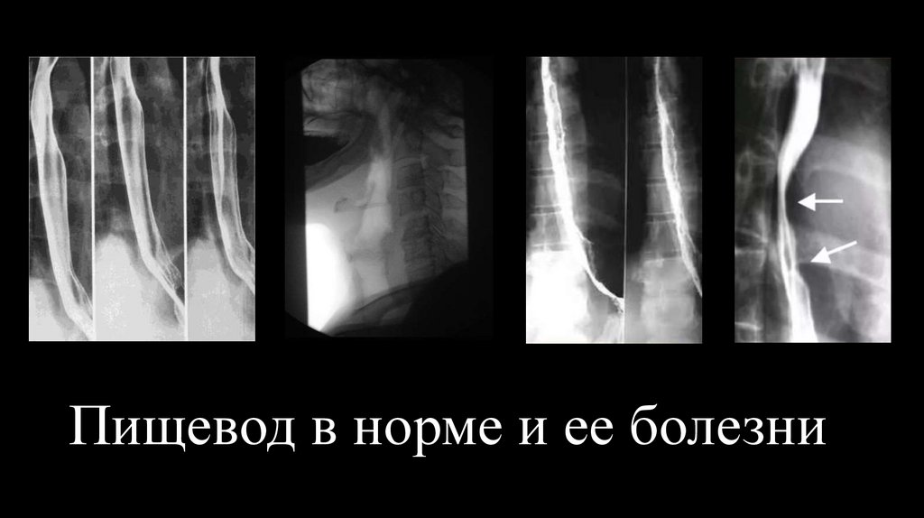 Пищевод в норме и ее болезни