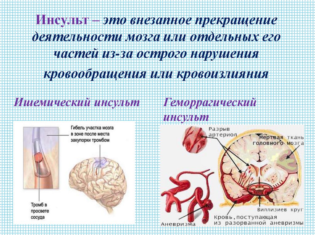 Инсульт – это внезапное прекращение деятельности мозга или отдельных его частей из-за острого нарушения кровообращения или