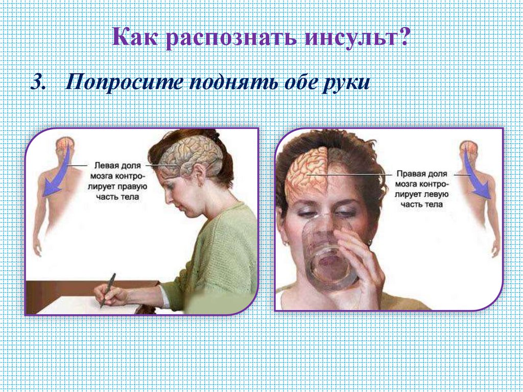 Как распознать инсульт?