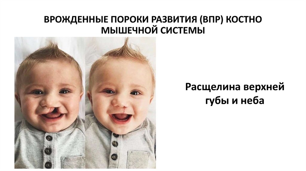 ВРОЖДЕННЫЕ ПОРОКИ РАЗВИТИЯ (ВПР) КОСТНО МЫШЕЧНОЙ СИСТЕМЫ