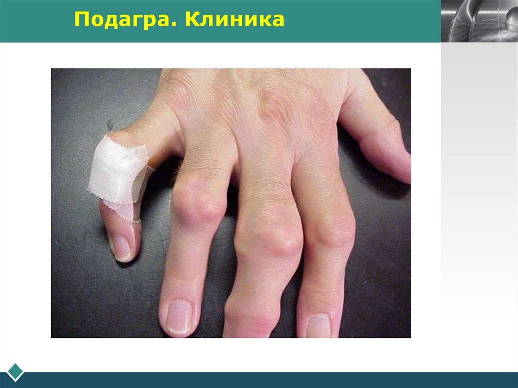 Подагра. Клиника
