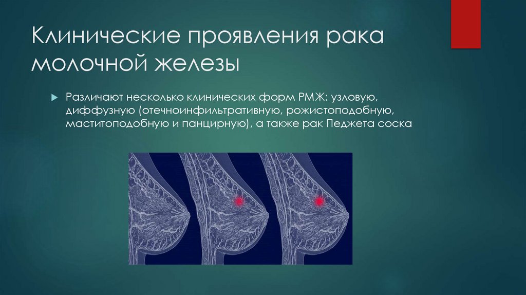 Клинические проявления рака молочной железы