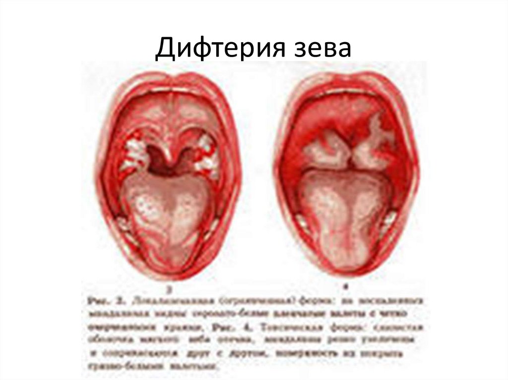 Дифтерия зева