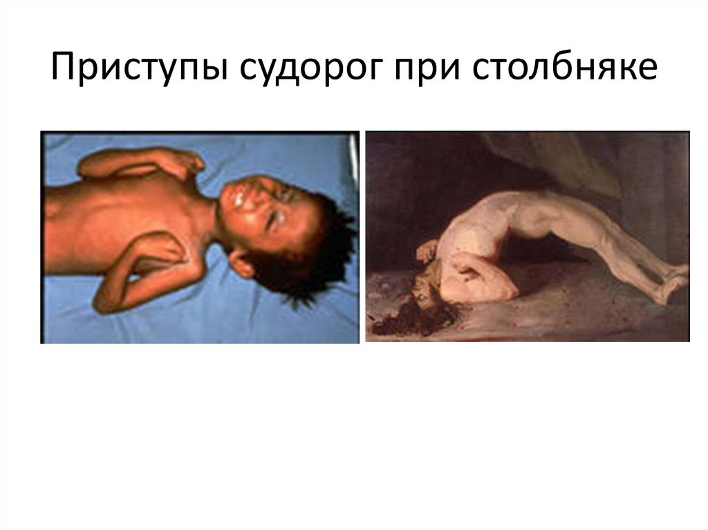 Приступы судорог при столбняке