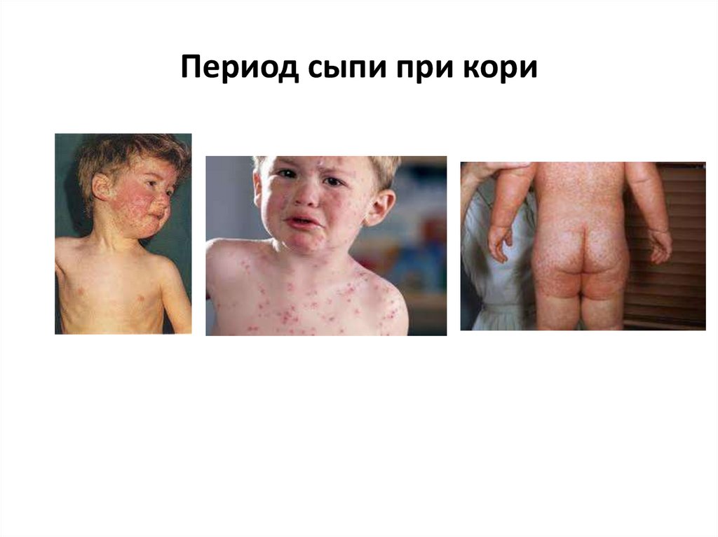 Период сыпи при кори