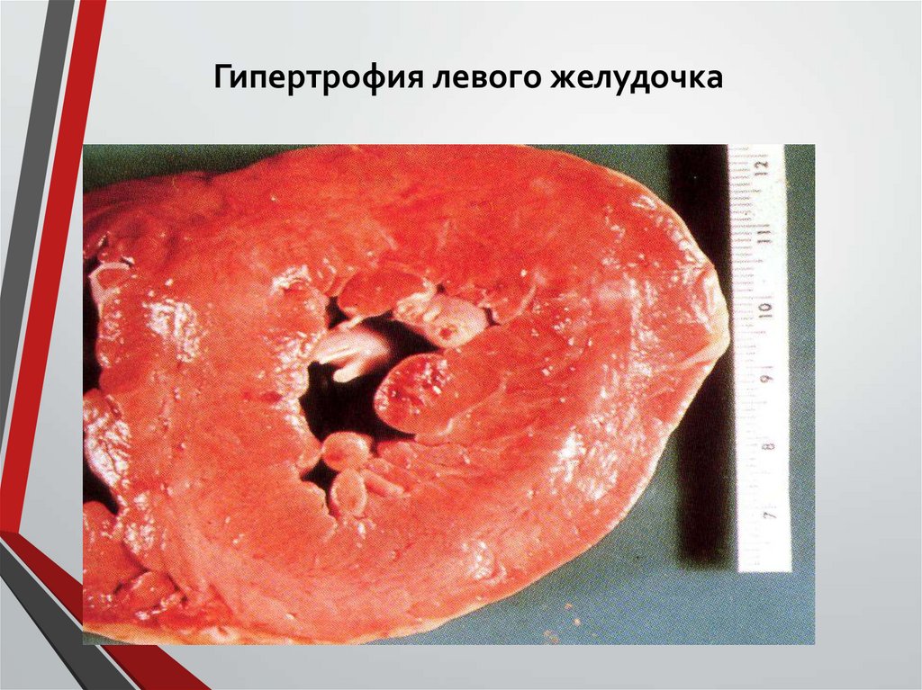 Гипертрофия левого желудочка