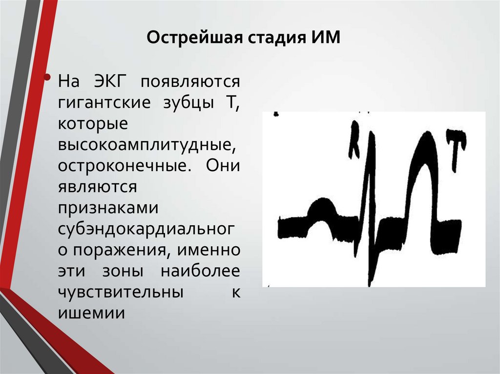 Острейшая стадия ИМ