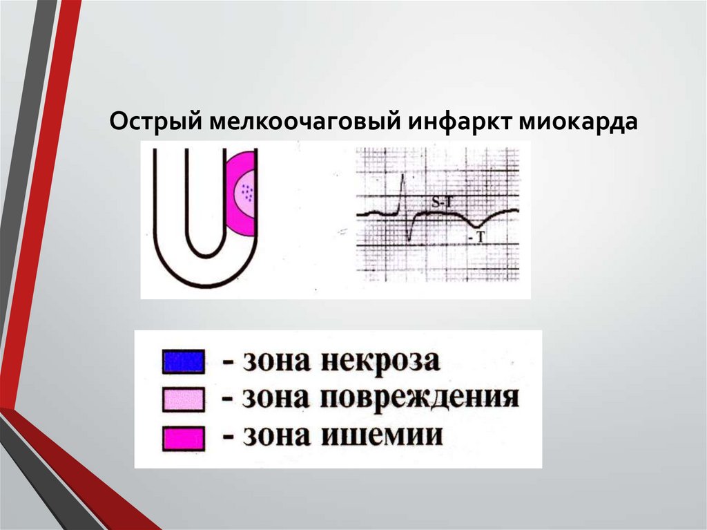Острый мелкоочаговый инфаркт миокарда