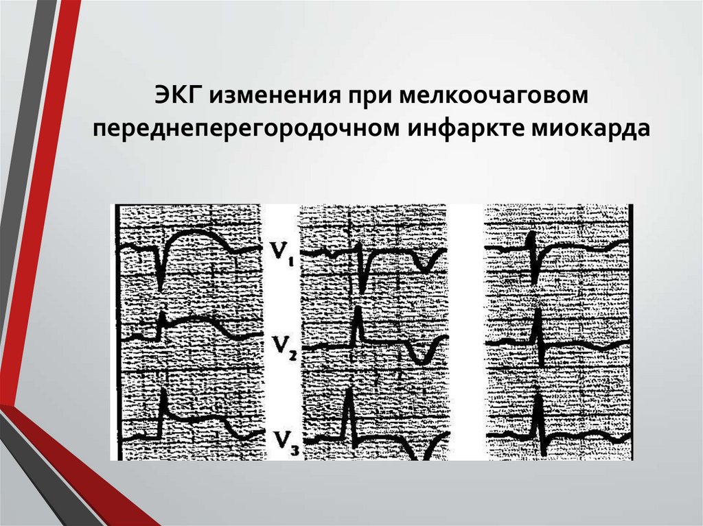 ЭКГ изменения при мелкоочаговом переднеперегородочном инфаркте миокарда