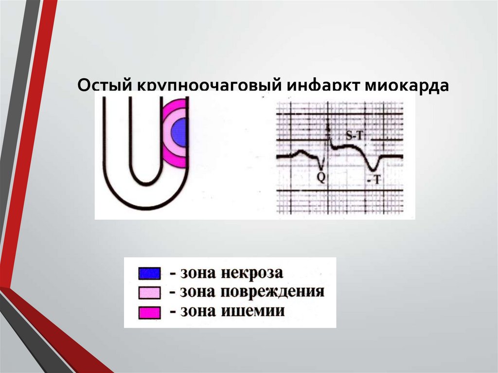 Остый крупноочаговый инфаркт миокарда
