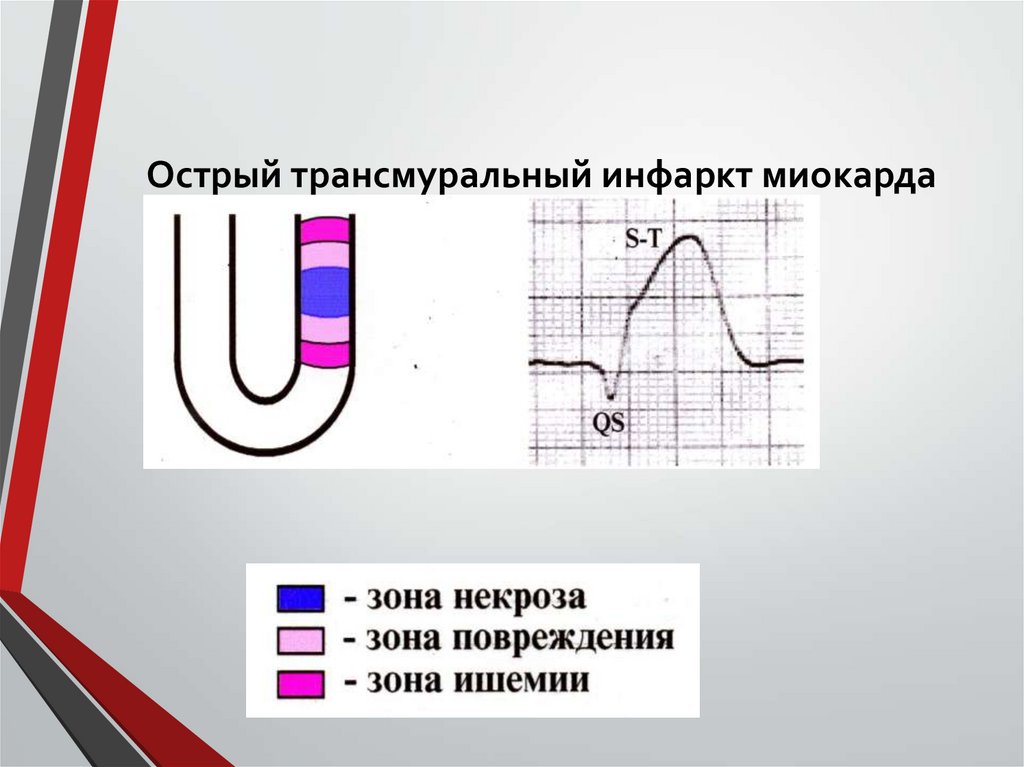 Острый трансмуральный инфаркт миокарда