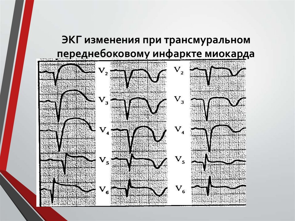 ЭКГ изменения при трансмуральном переднебоковому инфаркте миокарда