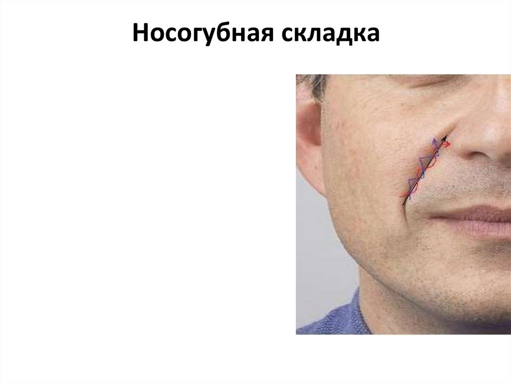 Носогубная складка