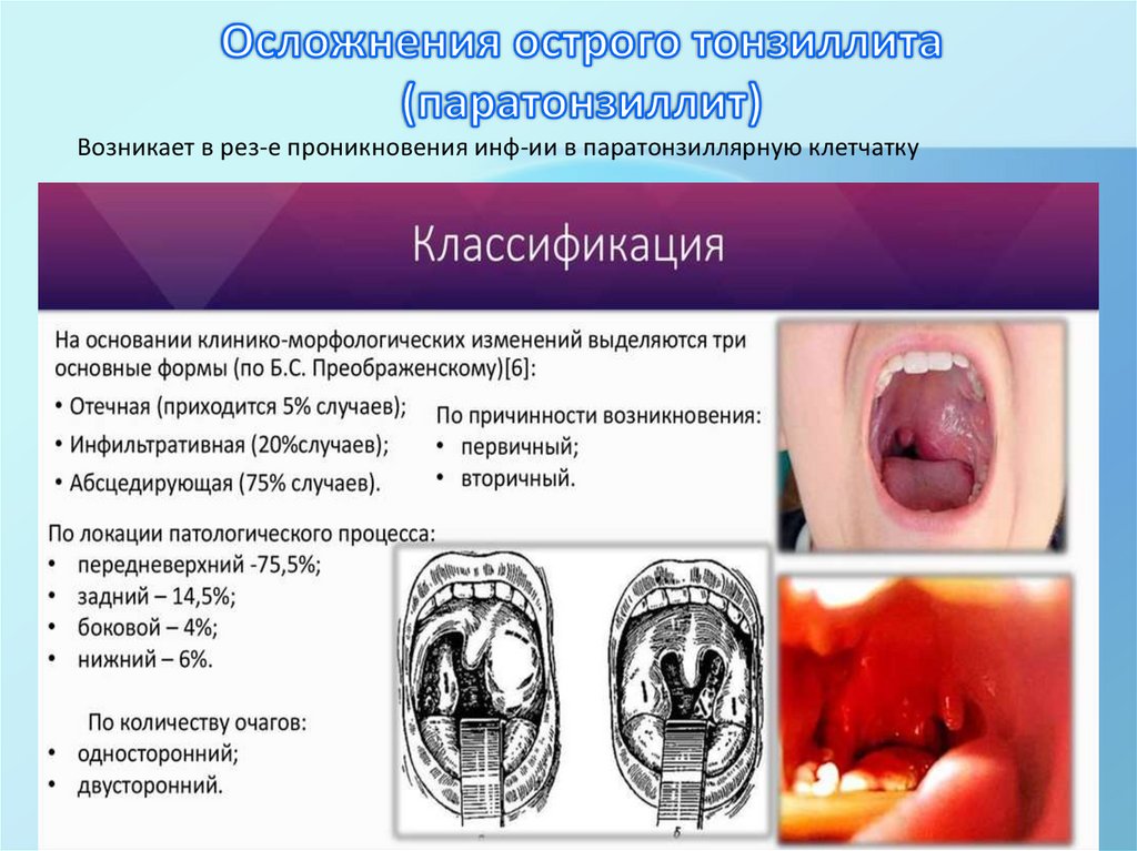 Осложнения острого тонзиллита (паратонзиллит)