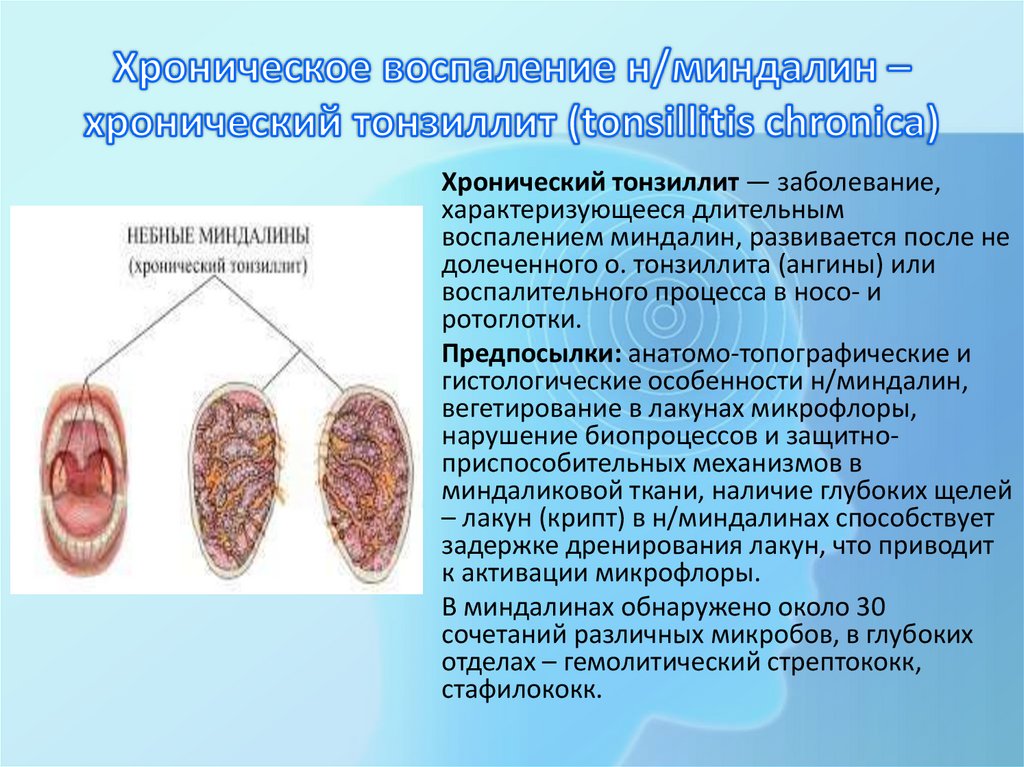 Хроническое воспаление н/миндалин – хронический тонзиллит (tonsillitis chronica)