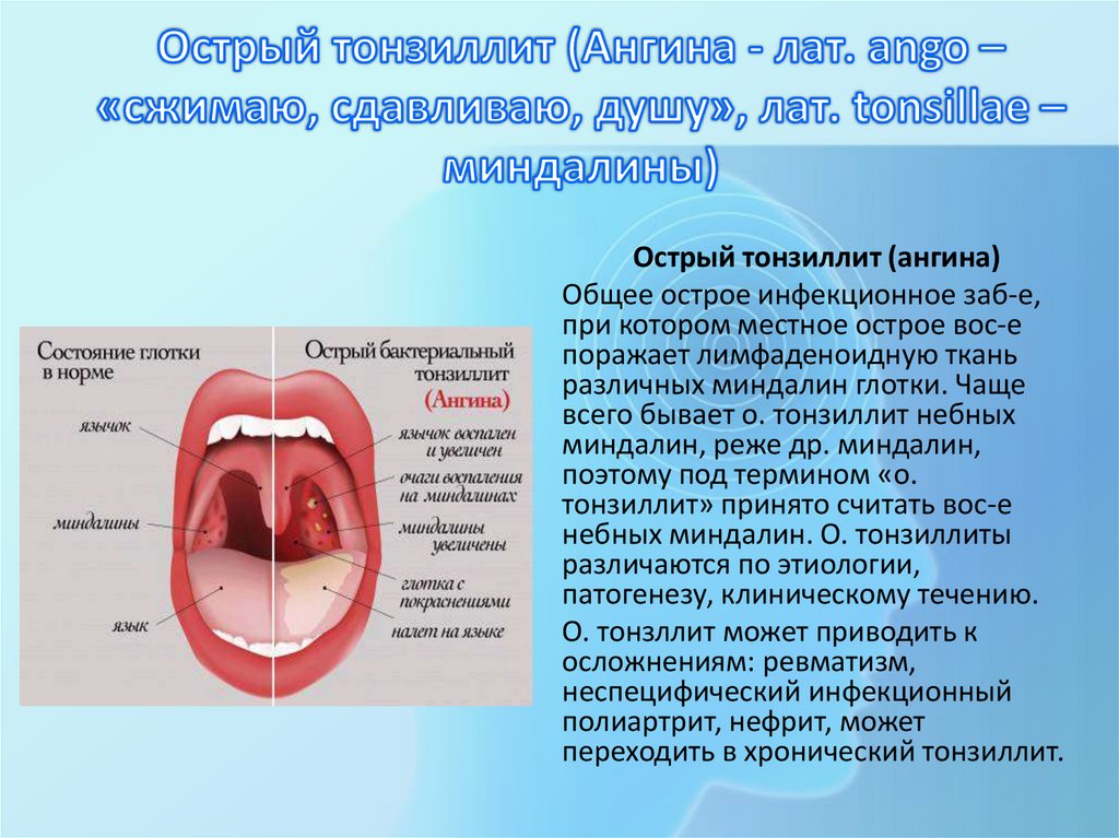 Острый тонзиллит (Ангина - лат. ango – «сжимаю, сдавливаю, душу», лат. tonsillae – миндалины)