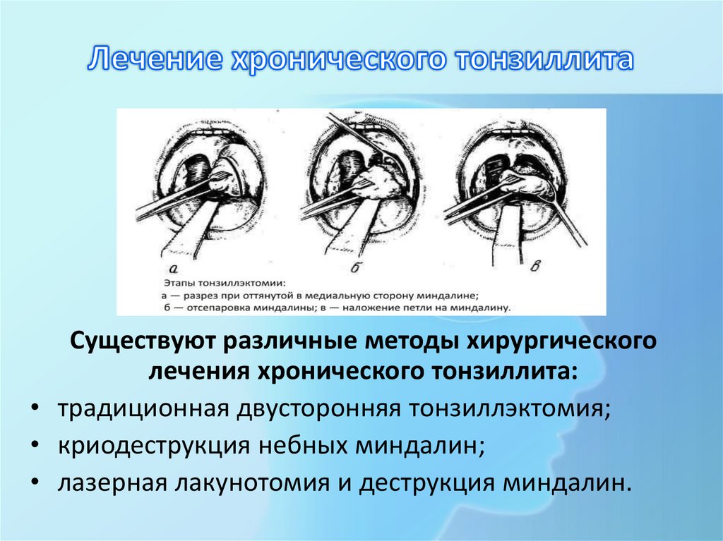 Лечение хронического тонзиллита