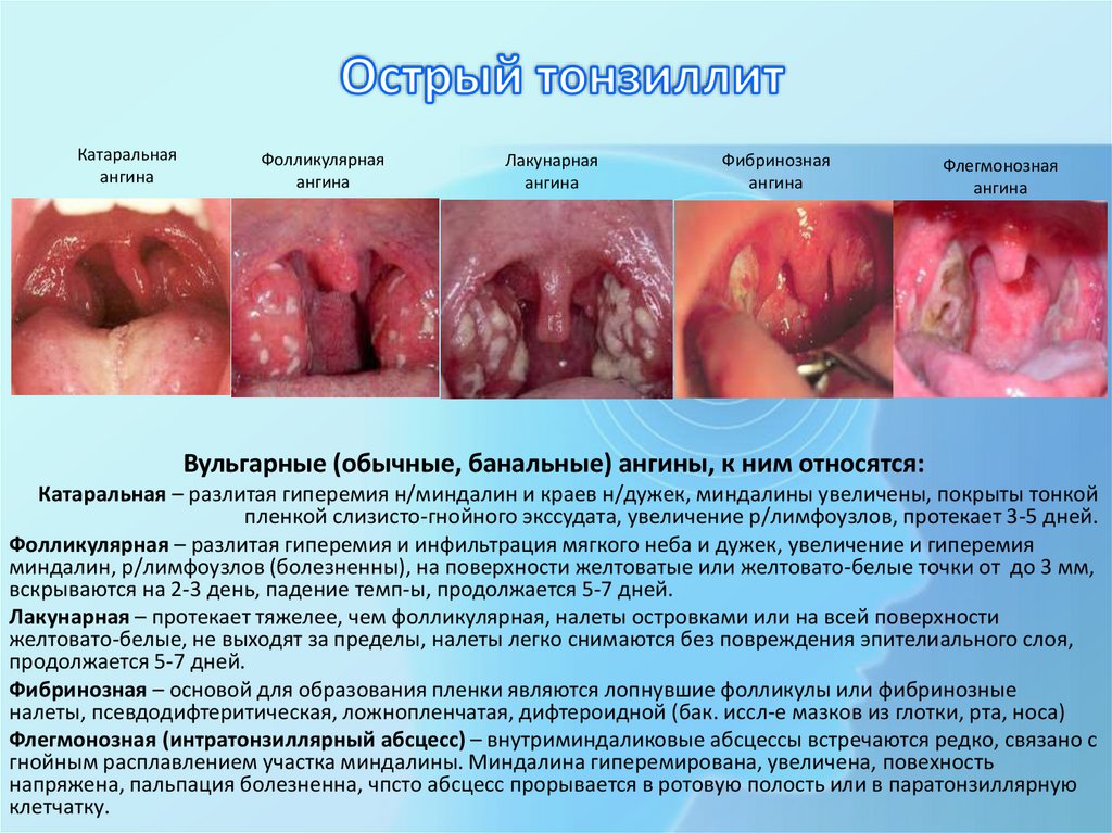 Острый тонзиллит