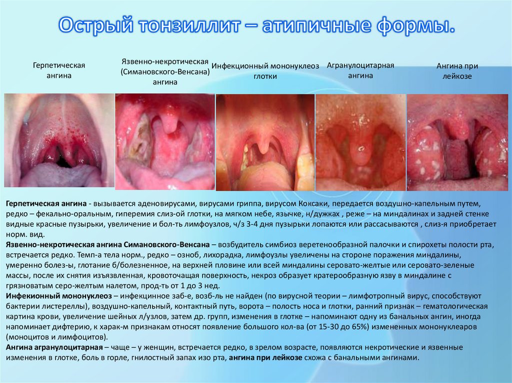 Острый тонзиллит – атипичные формы.