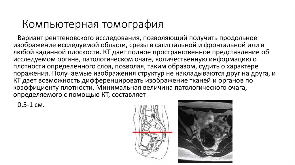 Компьютерная томография