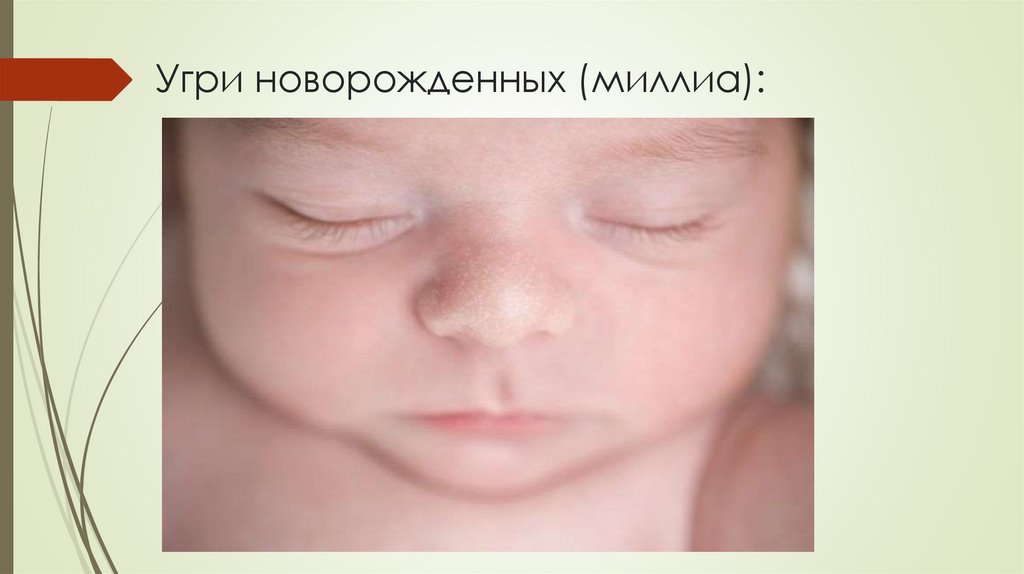 Угри новорожденных (миллиа):