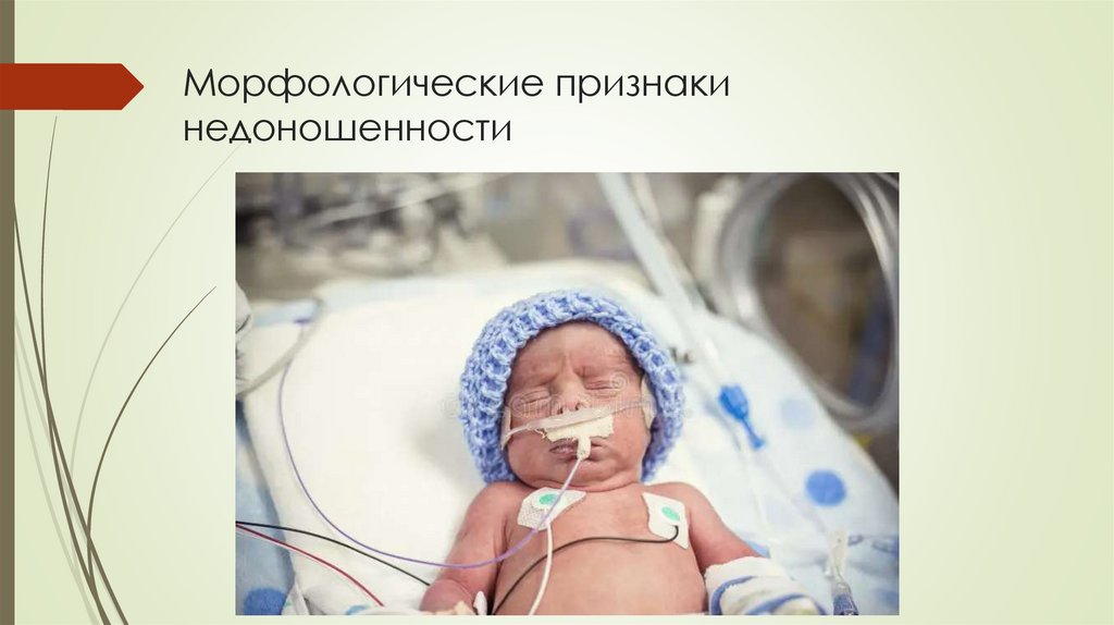 Морфологические признаки недоношенности
