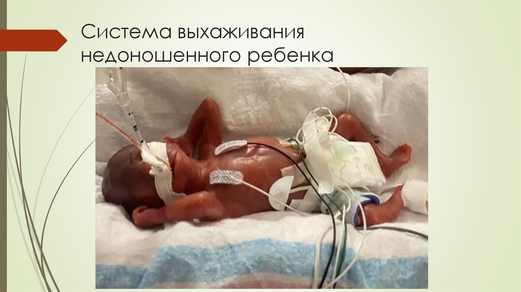 Система выхаживания недоношенного ребенка